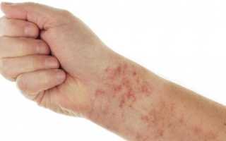Как выявить и лечить аллергию, вызванную глистами?