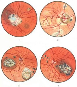 Токсоплазмоз глаз симптомы и лечение у людей thumbnail