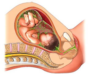 Заболеванию подвергаются в основном дети во время родов женщины, имеющей данную патологию