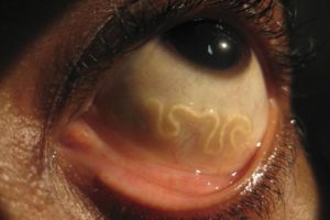 Глазной дирофиляриоз