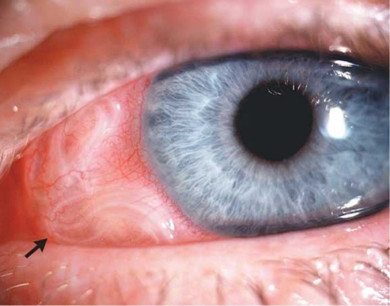 Дирофиляриоз у человека - симптомы и лечение