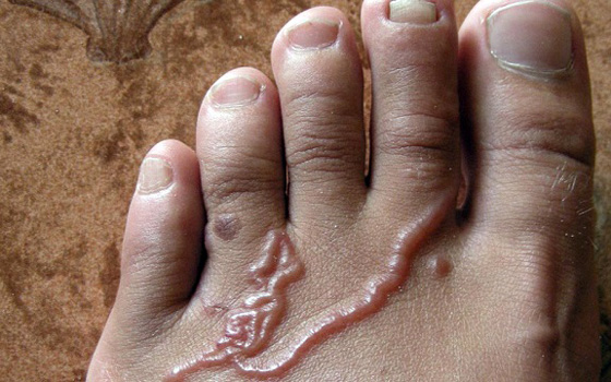 Лечение ног от паразит thumbnail