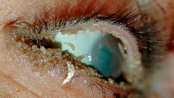 Заражение глаза - офтальмомиаз